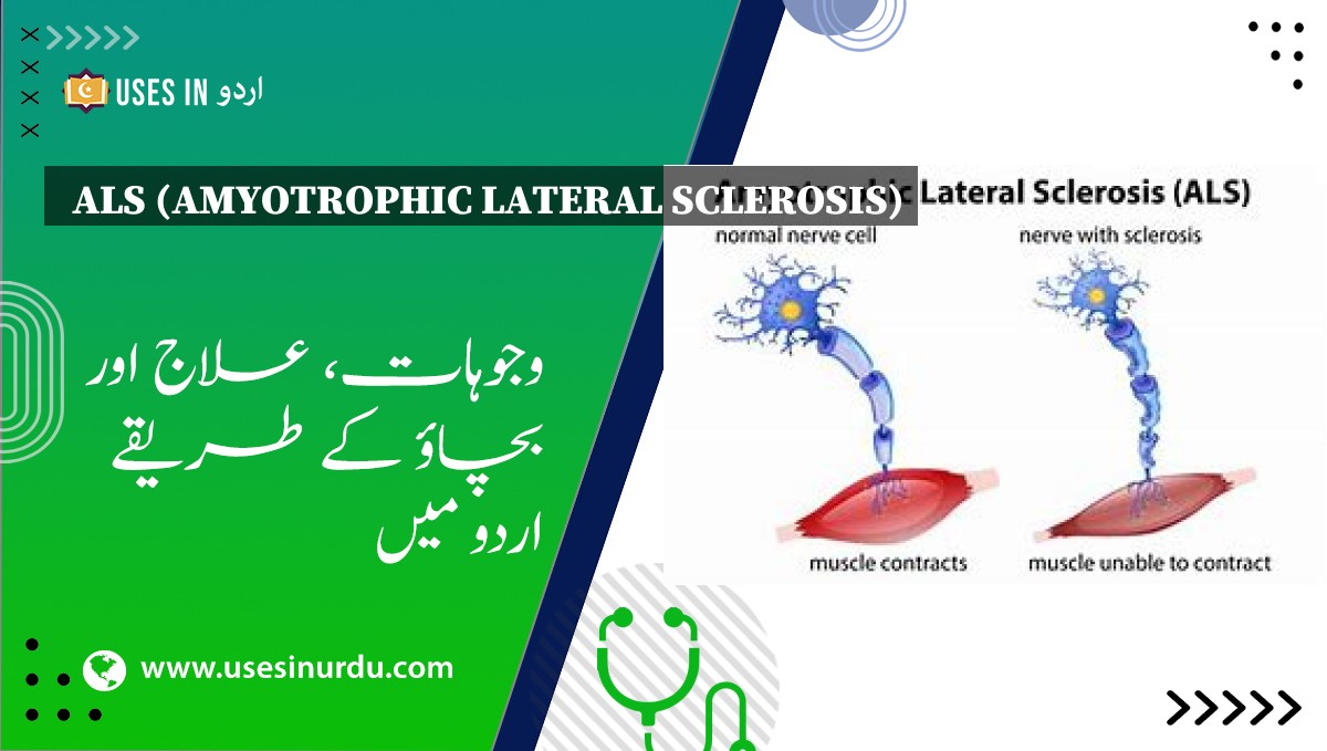 ALS (Amyotrophic Lateral Sclerosis)