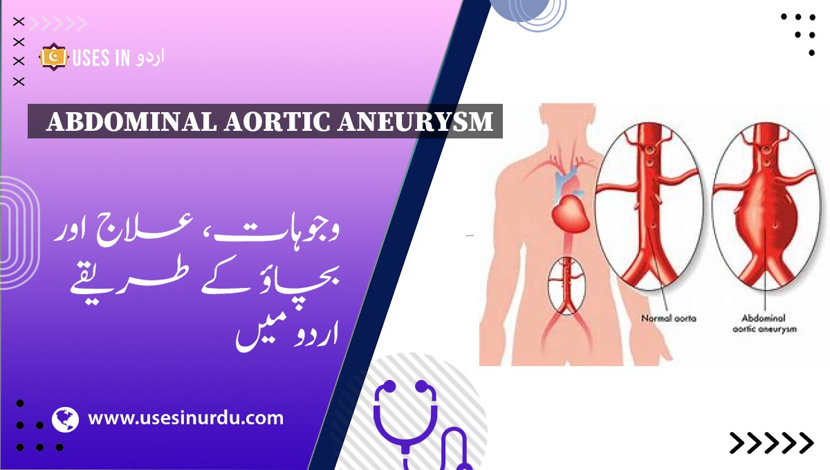 Abdominal Aortic Aneurysm