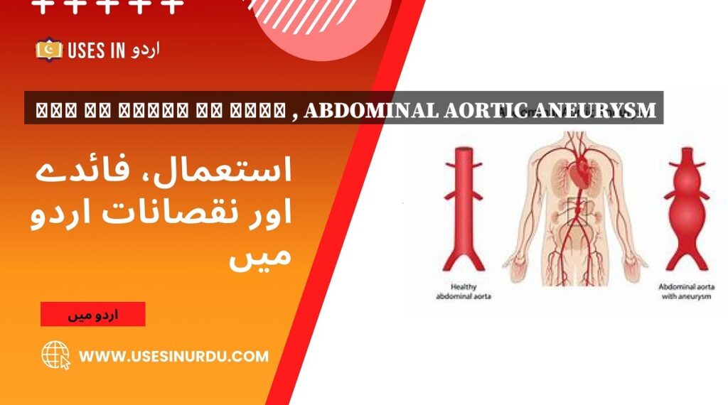 پیٹ کی شریان کا شگاف , Abdominal Aortic Aneurysm