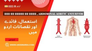 پیٹ کی شریان کا شگاف , Abdominal Aortic Aneurysm