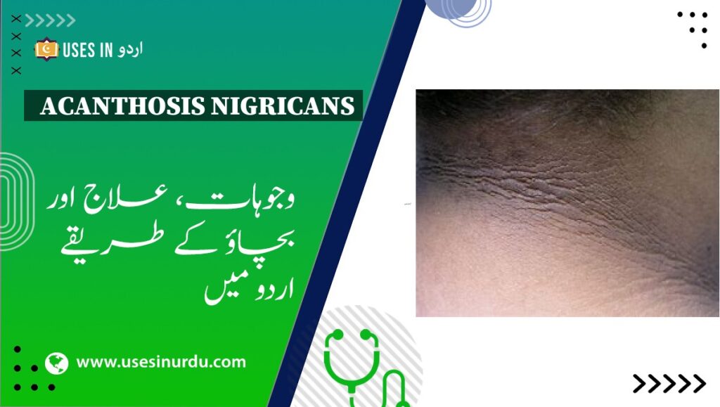 Acanthosis Nigricans