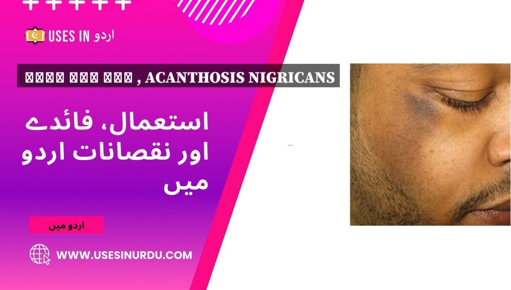 سیاہ فام داغ , Acanthosis Nigricans