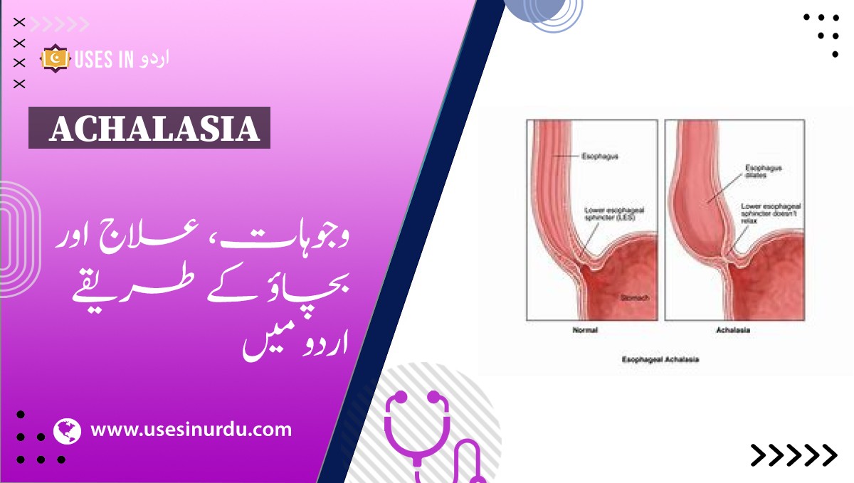 Achalasia