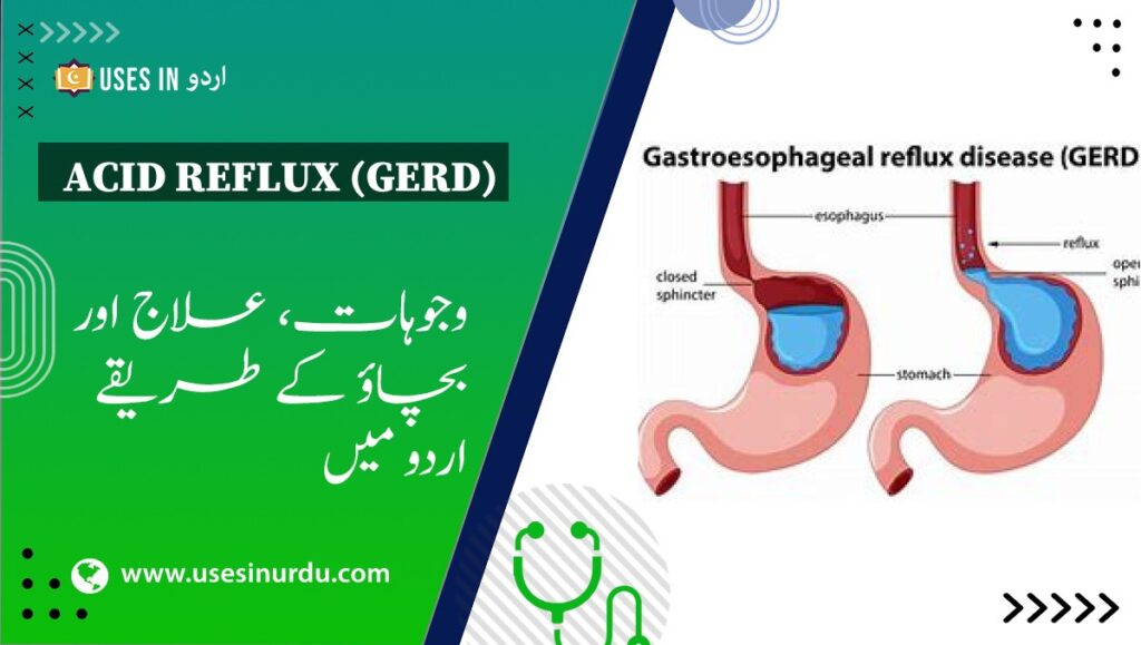 Acid Reflux (GERD)