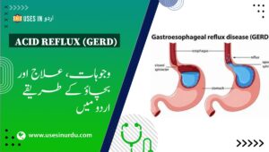 Acid Reflux (GERD)