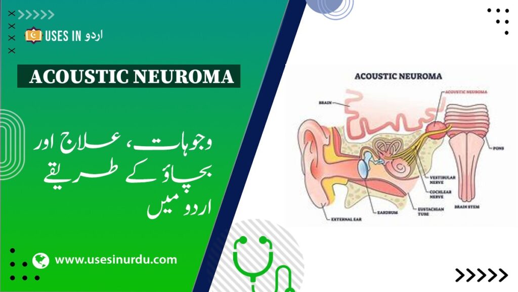 Acoustic Neuroma