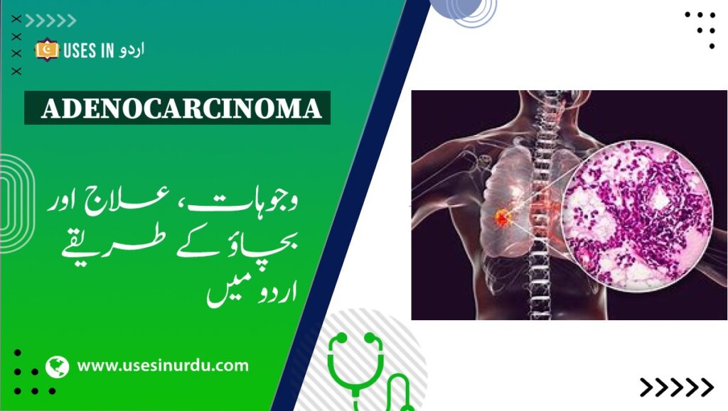 Adenocarcinoma