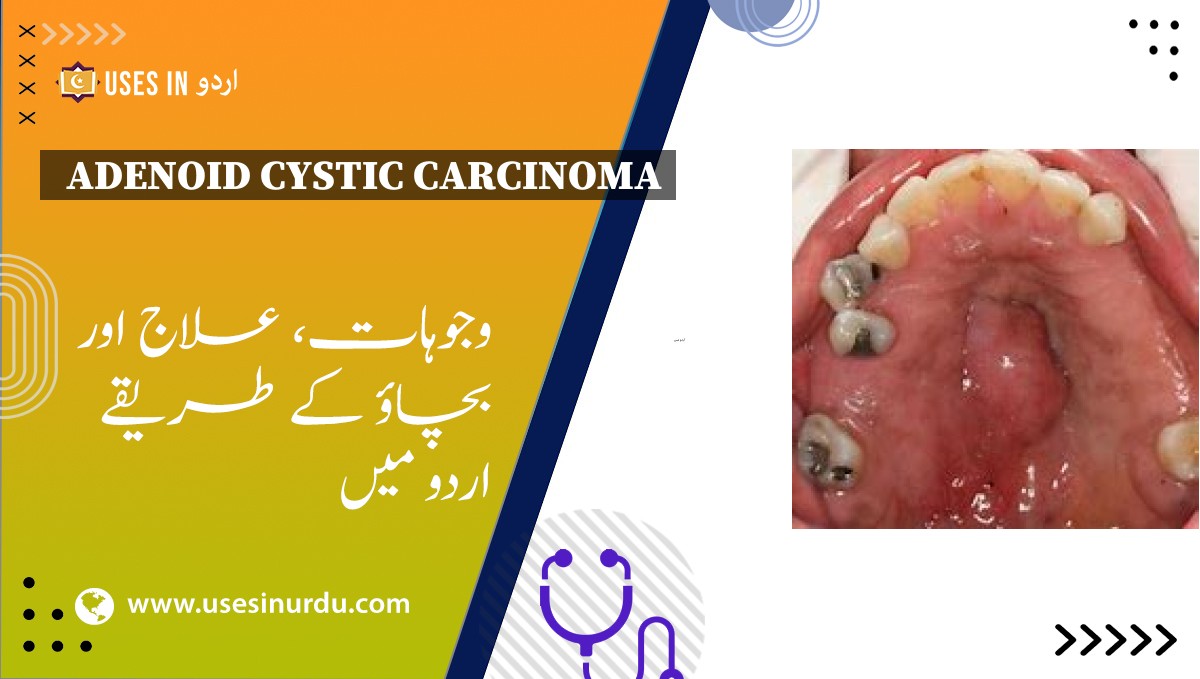 Adenoid Cystic Carcinoma