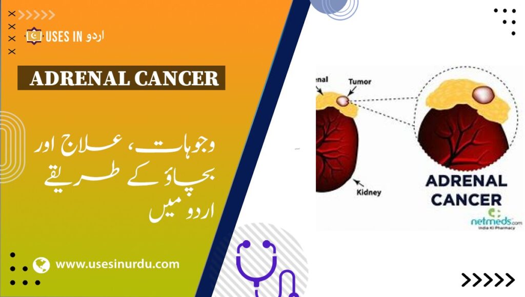 Adrenal Cancer