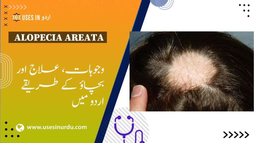 Alopecia Areata