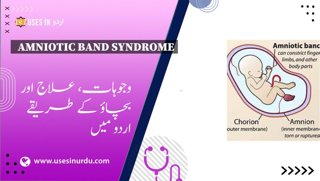 Amniotic Band Syndrome