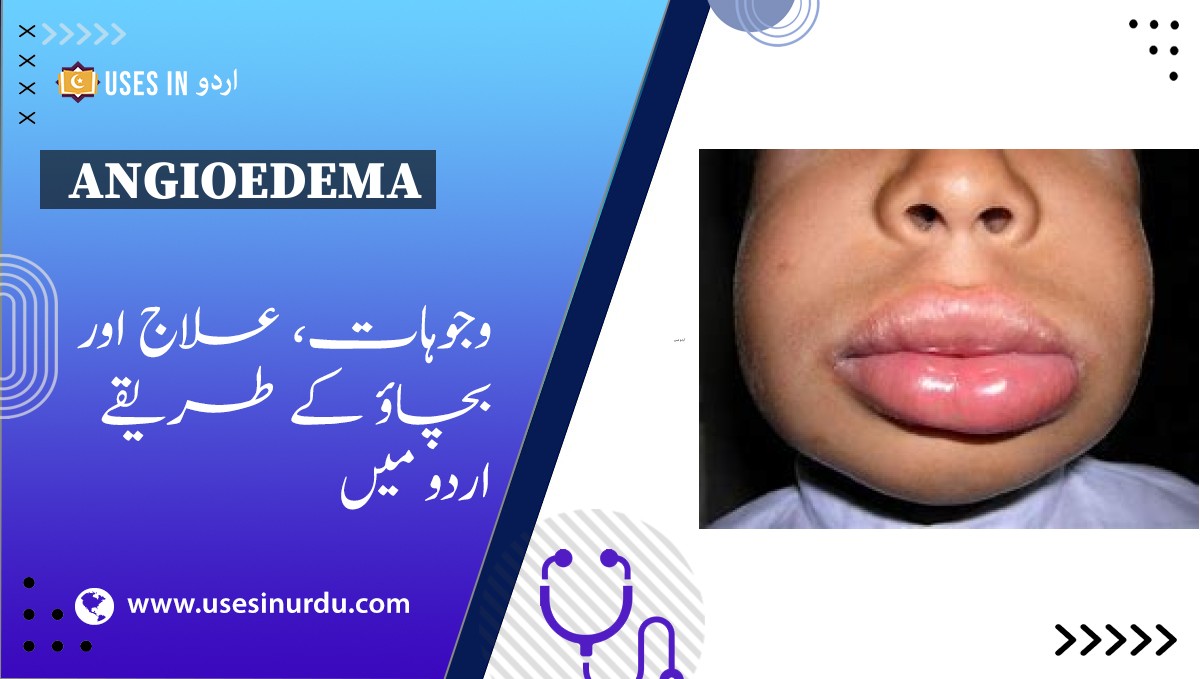 Angioedema