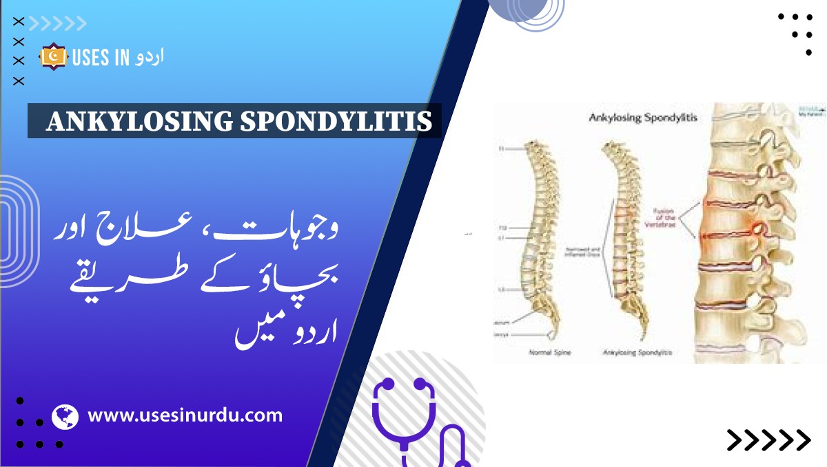 Ankylosing Spondylitis