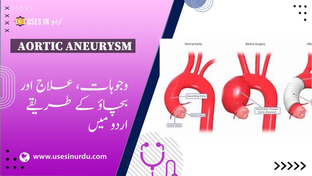 Aortic Aneurysm