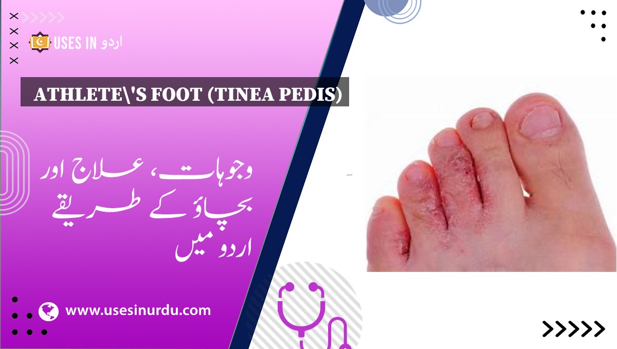 Athlete's Foot (Tinea Pedis)