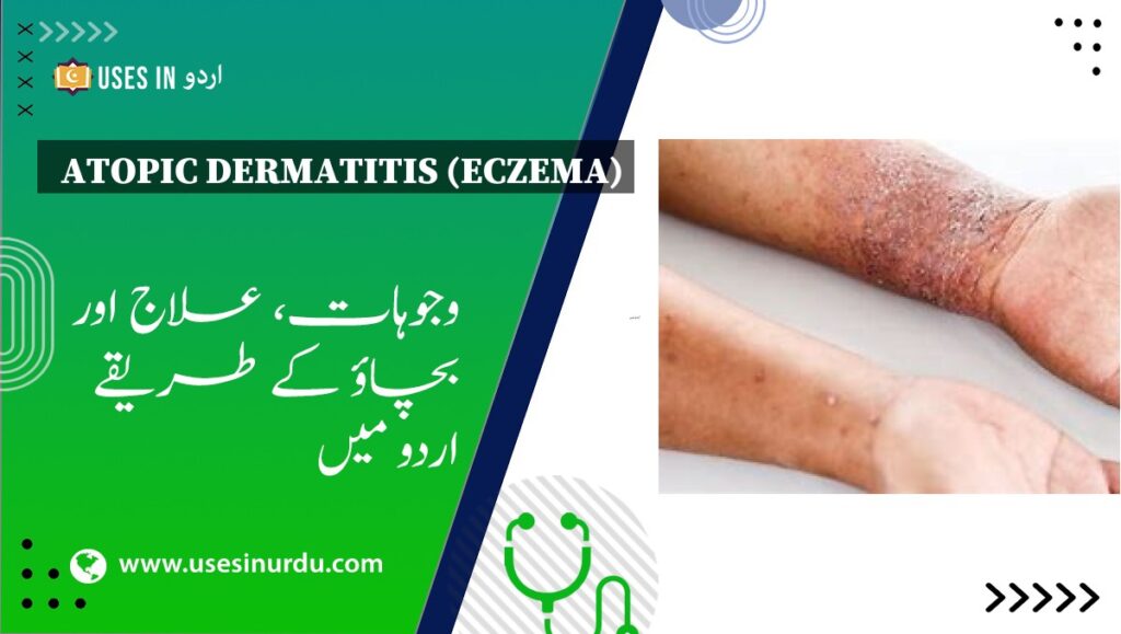 Atopic Dermatitis (Eczema)