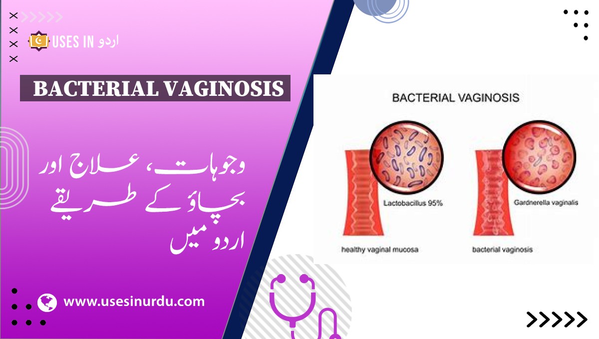 Bacterial Vaginosis