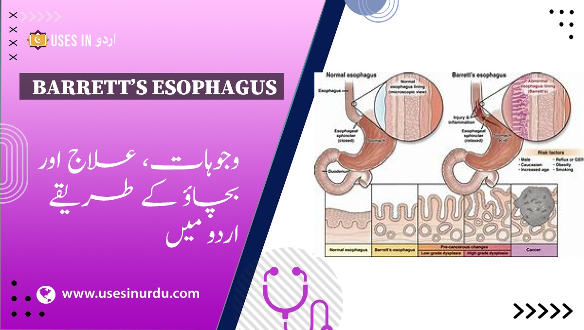 Barrett’s Esophagus