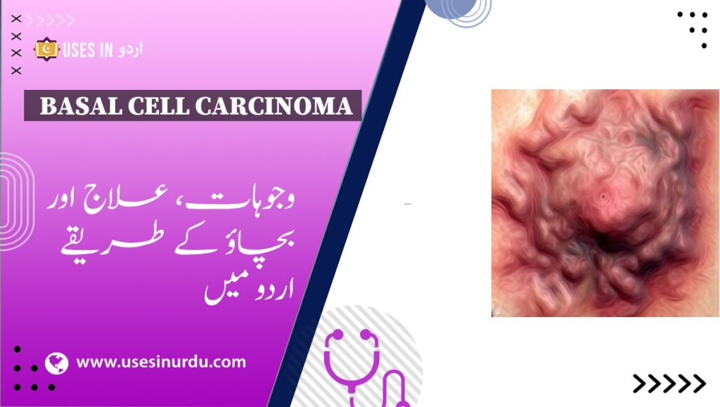 Basal Cell Carcinoma