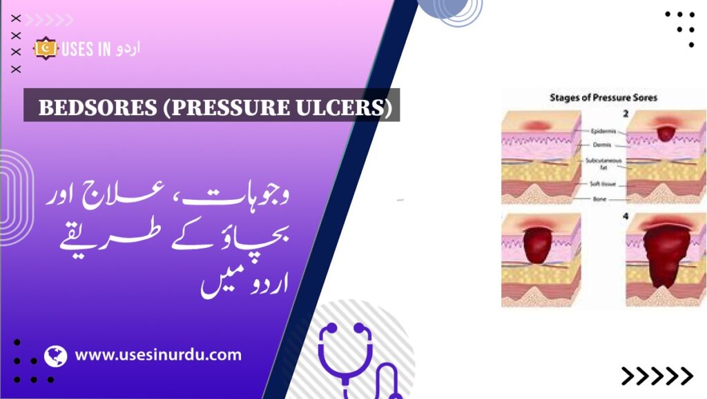 Bedsores (Pressure Ulcers)