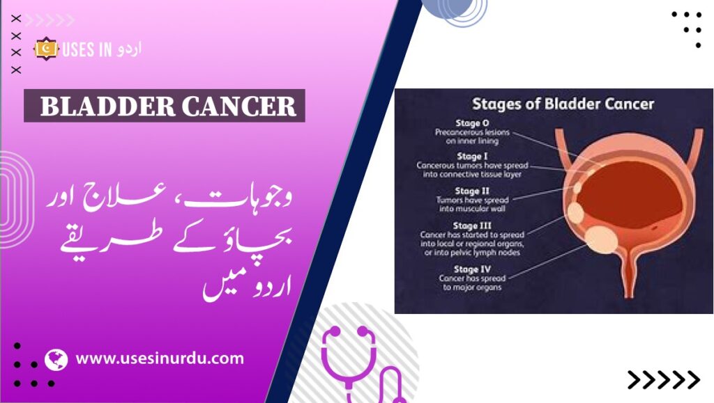 Bladder Cancer