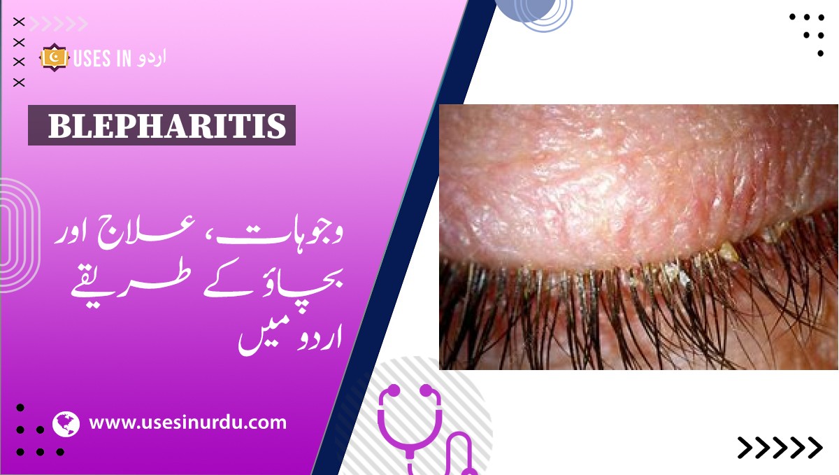 Blepharitis