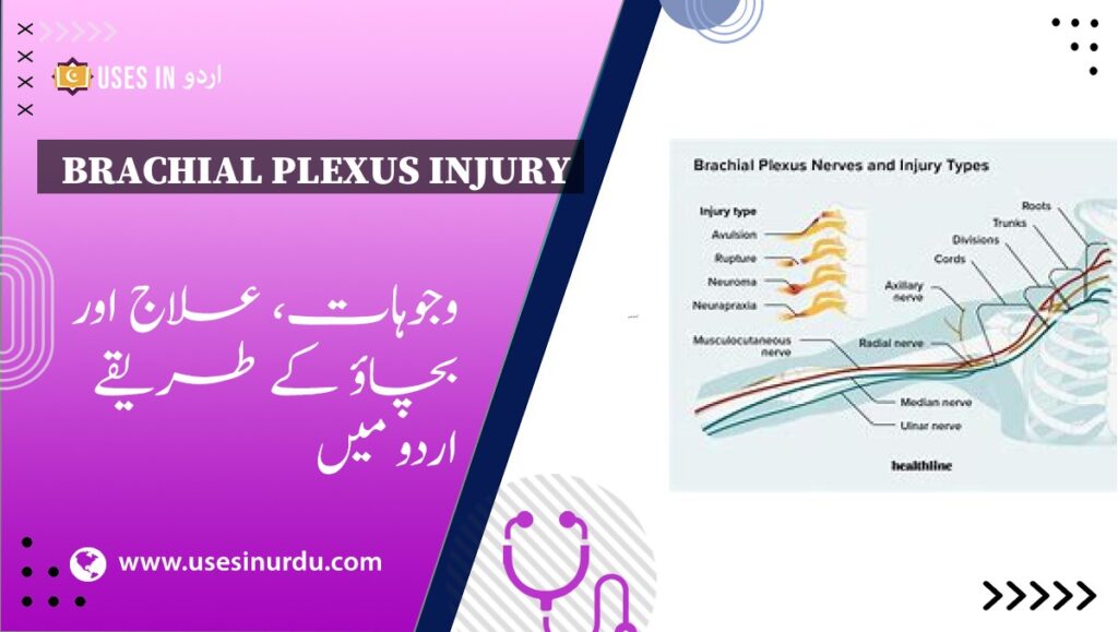 Brachial Plexus Injury