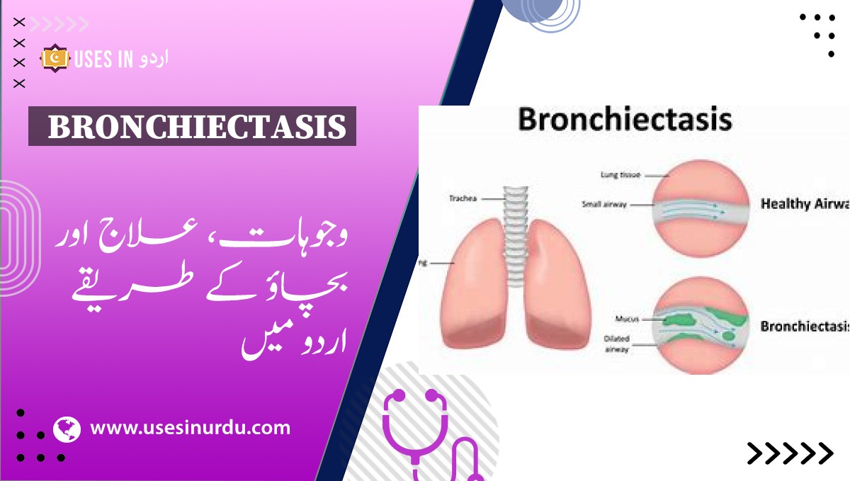 Bronchiectasis