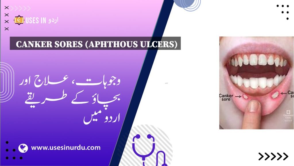 Canker Sores (Aphthous Ulcers)