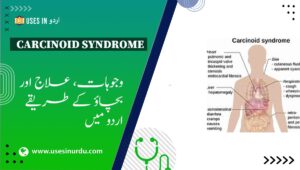 Carcinoid Syndrome