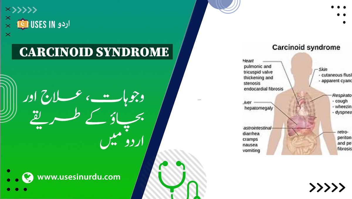 Carcinoid Syndrome