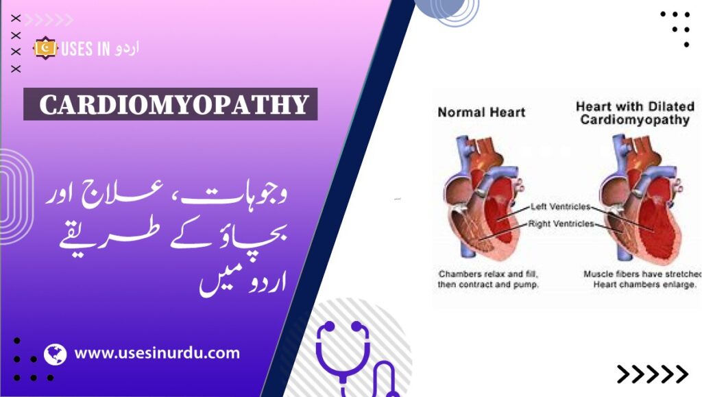 Cardiomyopathy