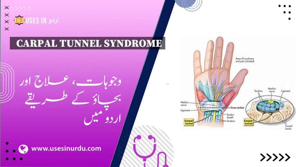 Carpal Tunnel Syndrome