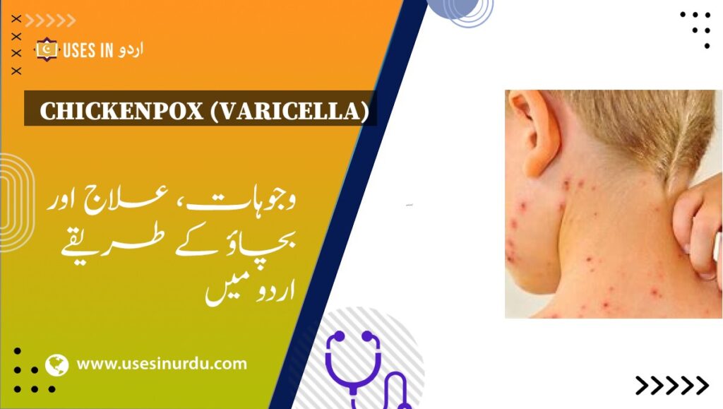 Chickenpox (Varicella)