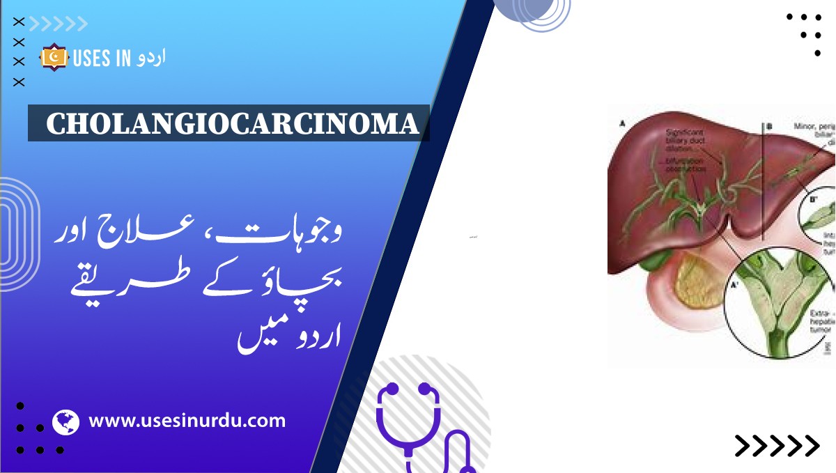 Cholangiocarcinoma