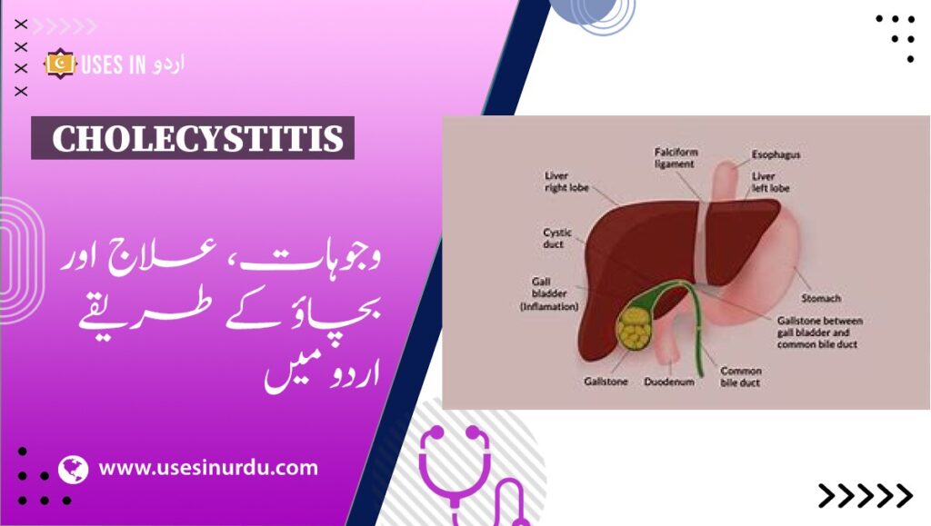 Cholecystitis