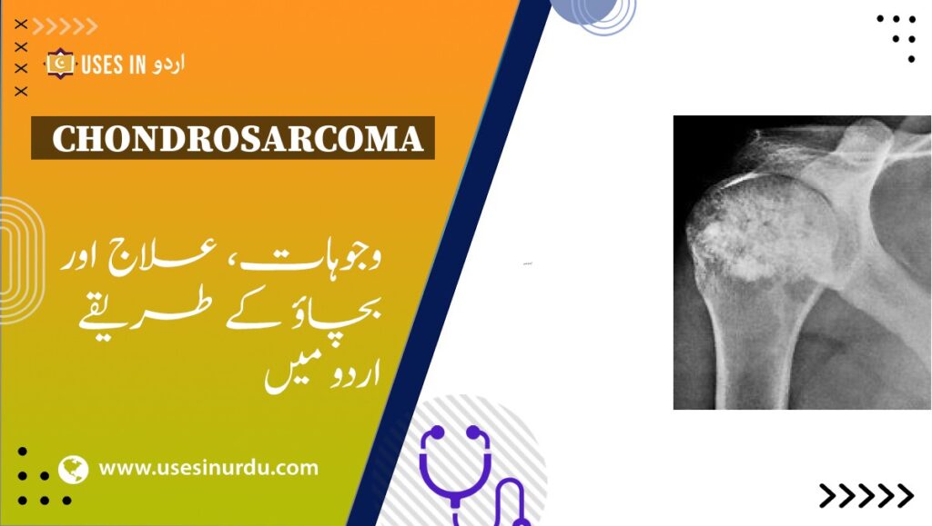 Chondrosarcoma