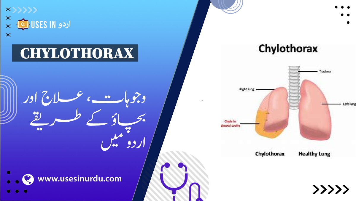 Chylothorax