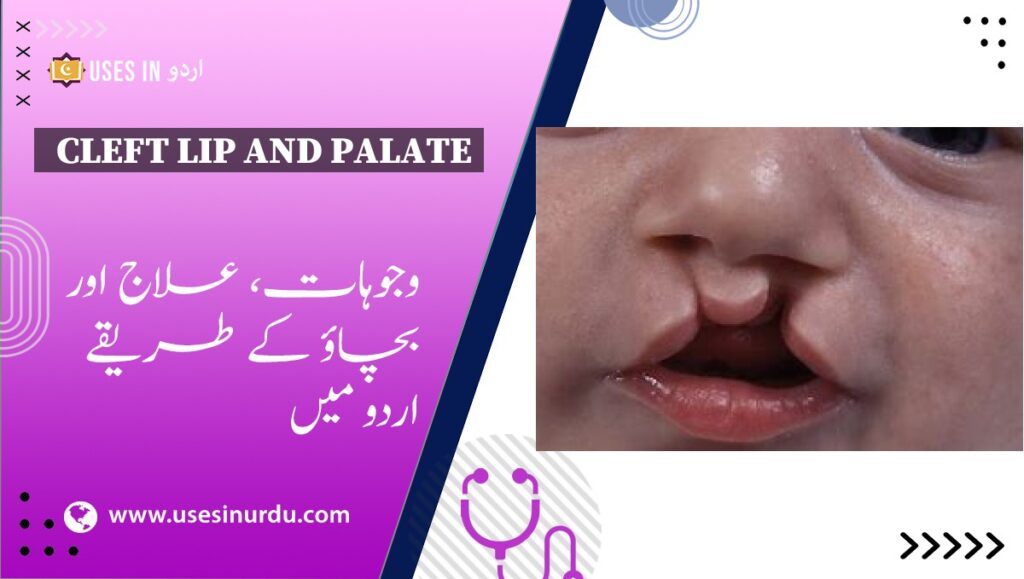 Cleft Lip and Palate