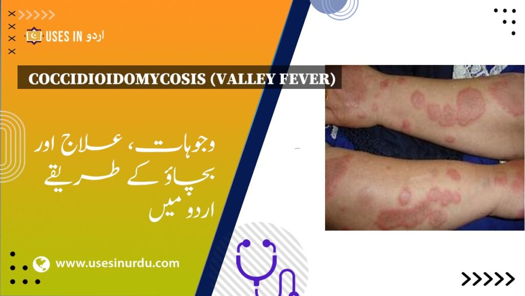 Coccidioidomycosis (Valley Fever)