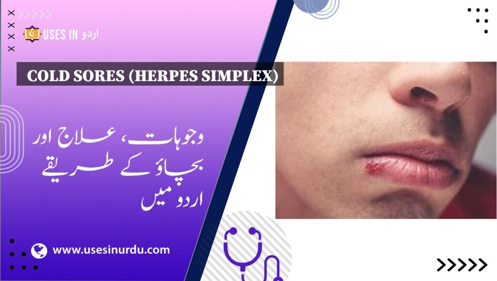 Cold Sores (Herpes Simplex)