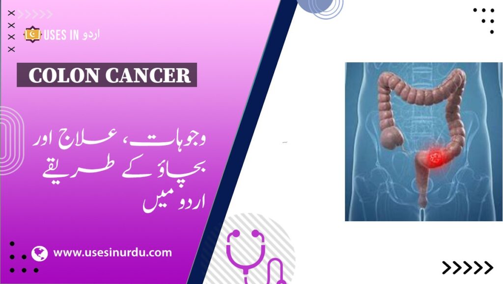 Colon Cancer