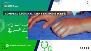 Complex Regional Pain Syndrome (CRPS)