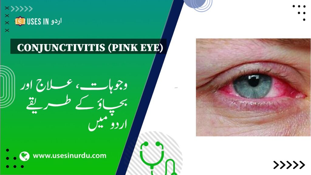 Conjunctivitis (Pink Eye)