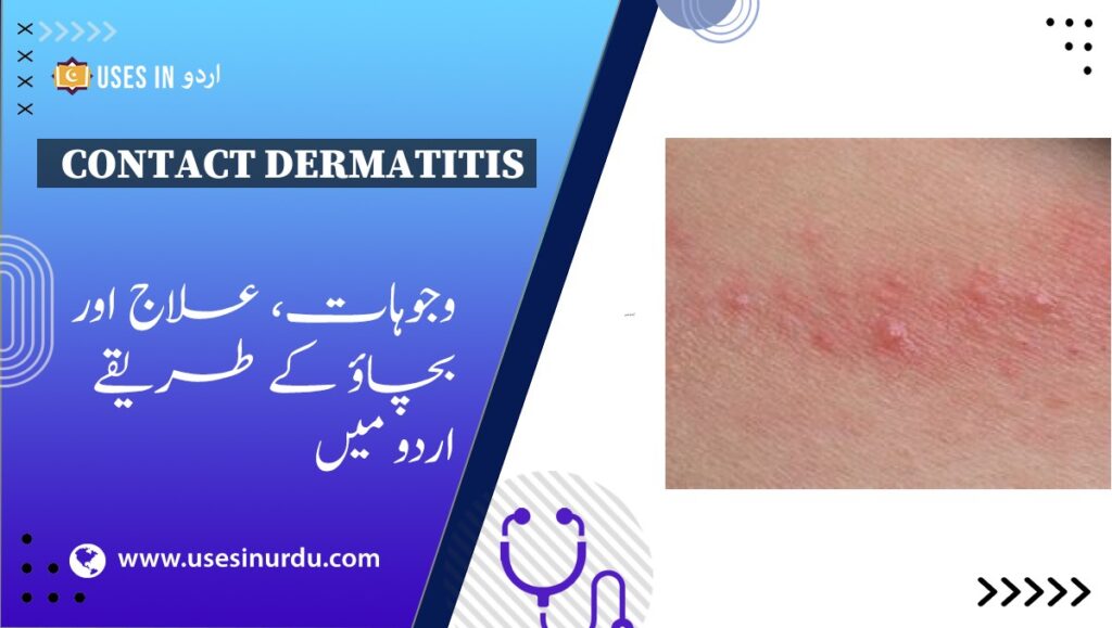 Contact Dermatitis