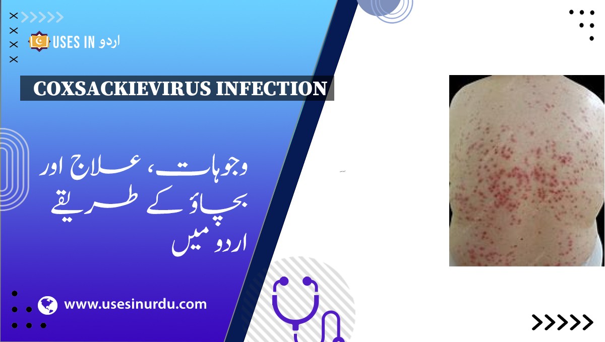 Coxsackievirus Infection