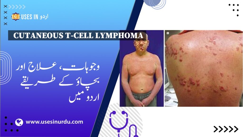 Cutaneous T-Cell Lymphoma