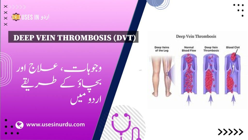 Deep Vein Thrombosis (DVT)