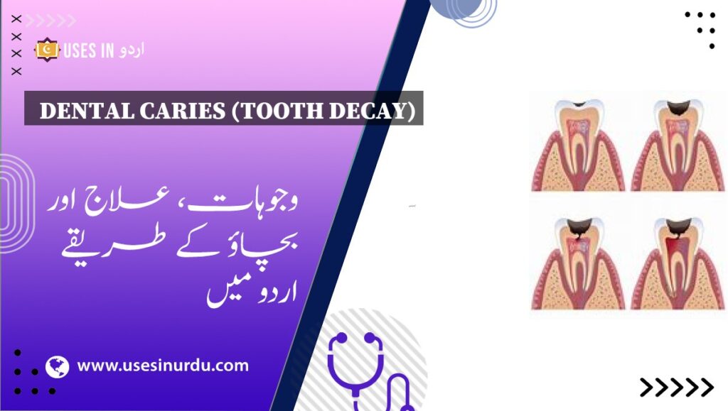 Dental Caries (Tooth Decay)