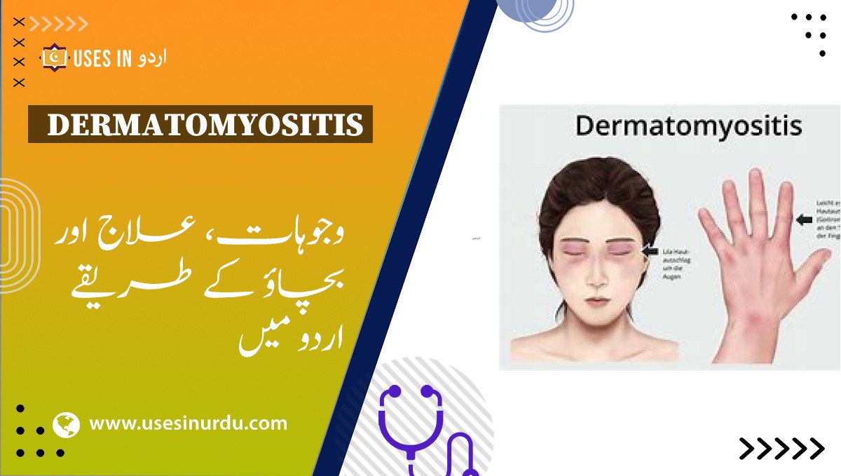 Dermatomyositis